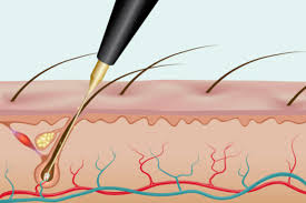 electrology